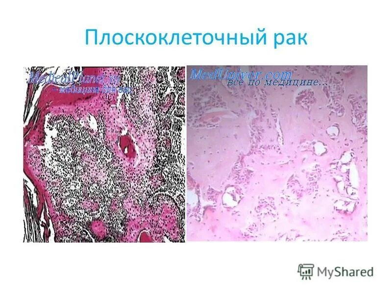 Плоскоклеточный рак горла фото Плоскоклеточный рак горла - Арт Минск.ру
