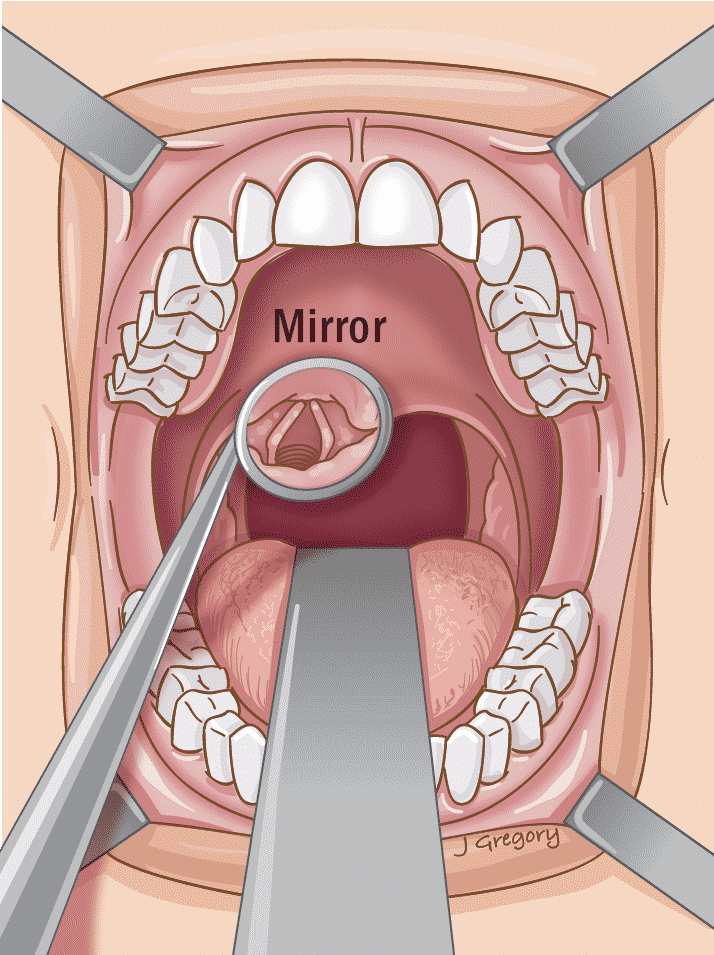 Плоскоклеточный рак горла фото What is Endoscopy * Cancer Basics * THANC Guide