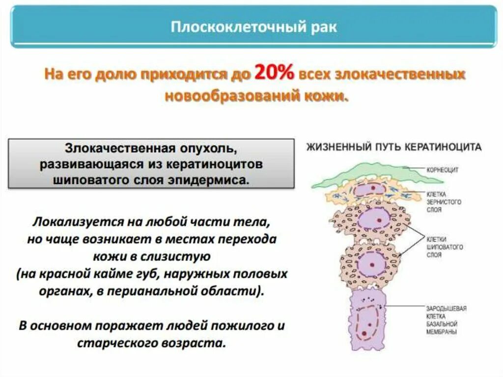 Плоскоклеточный рак кожи фото начальная стадия Базалоидные клетки: найдено 86 изображений