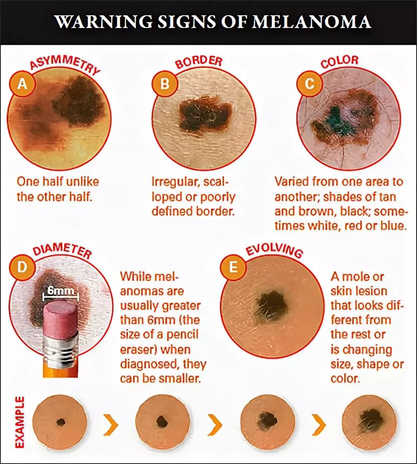 Плоскоклеточный рак кожи фото начальная стадия описание Warning Signs of Melanoma - ABCDEs