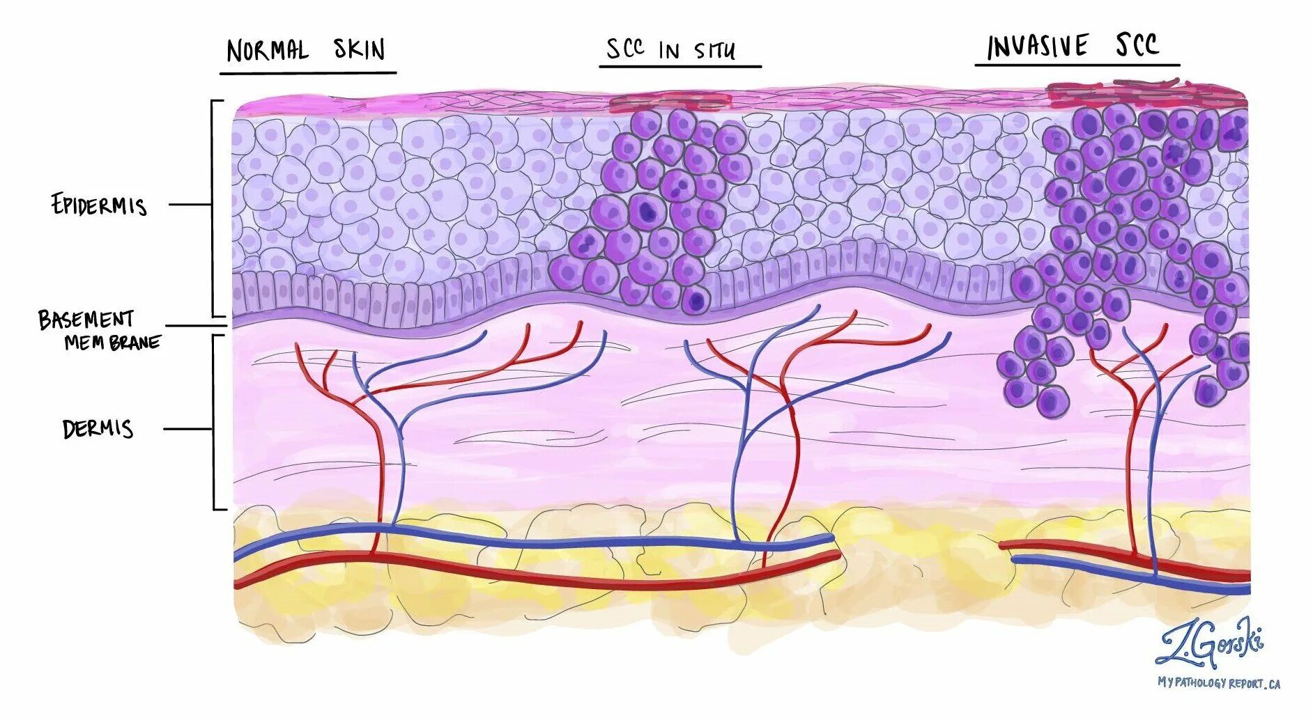 Плоскоклеточный рак кожи фото начальная стадия описание Patient Education - Dermatology Skin Cancer Experts