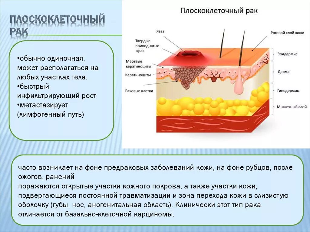 Плоскоклеточный рак кожи фото начальная стадия описание Рак клеток кожи: найдено 87 изображений