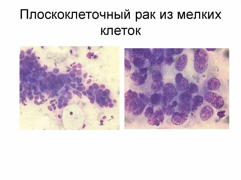 Плоскоклеточный рак кожи фото начальная стадия описание Цитологическая диагностика заболеваний женских половых органов - презентация онл