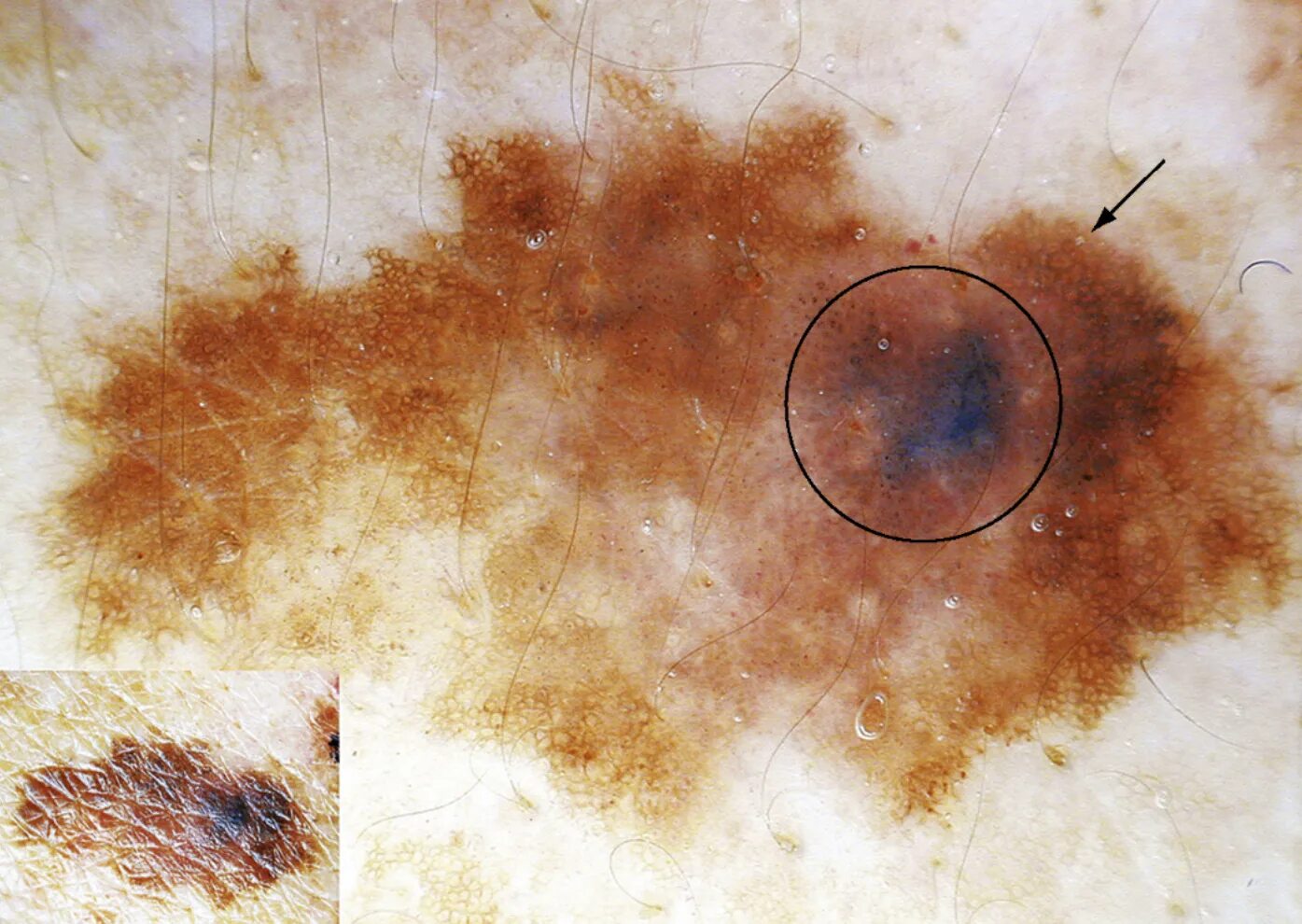 Плоскоклеточный рак кожи фото начальная стадия описание Melanoma Explained