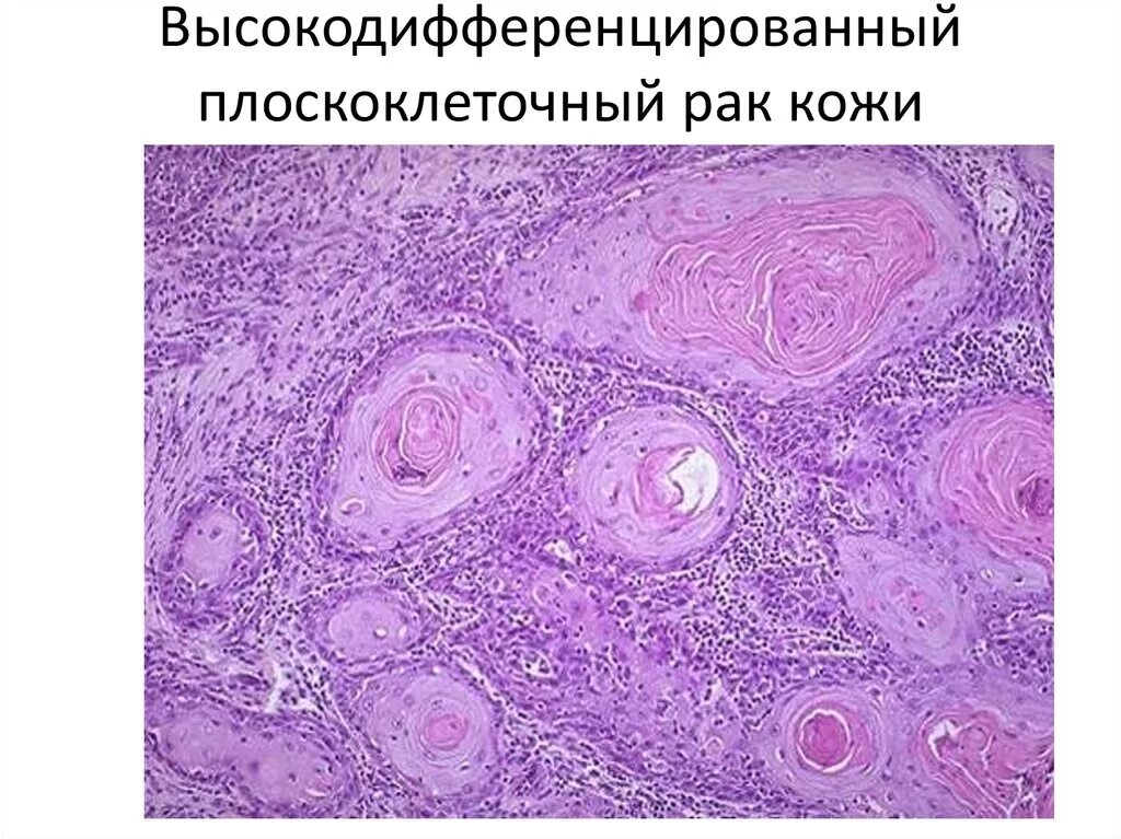 Плоскоклеточный рак кожи фото начальная стадия описание Опухолевый рост - презентация онлайн