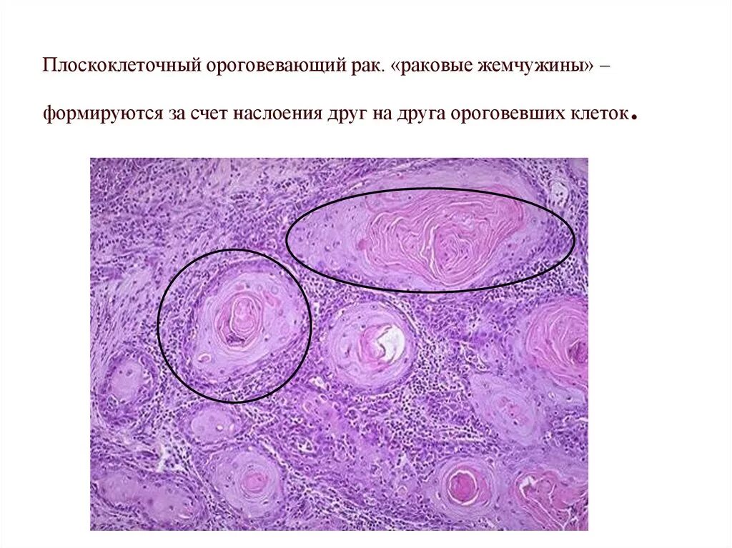 Плоскоклеточный рак кожи как выглядит фото Плоскоклеточными опухолями