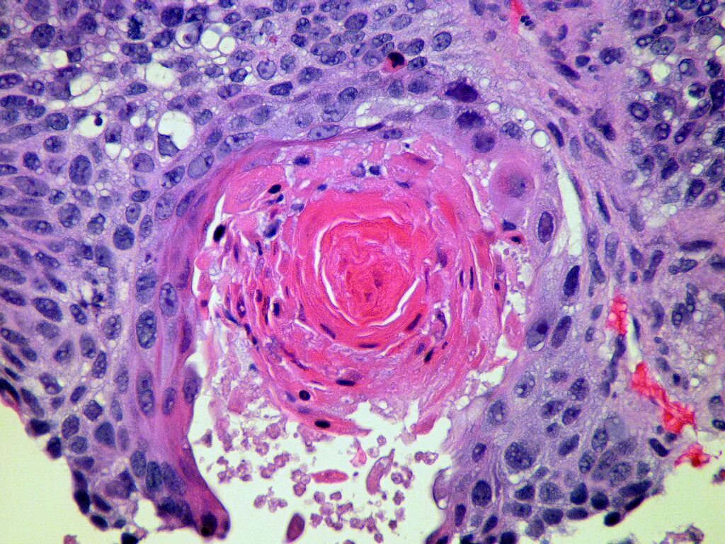 Плоскоклеточный рак кожи как выглядит фото Datei:Squamous cell carcinoma 3.jpg - Wikipedia