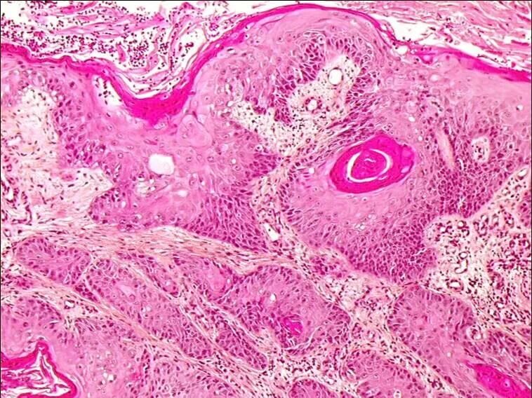 Плоскоклеточный рак кожи как выглядит фото Invasive Squamous Carcinoma - Eurocytology