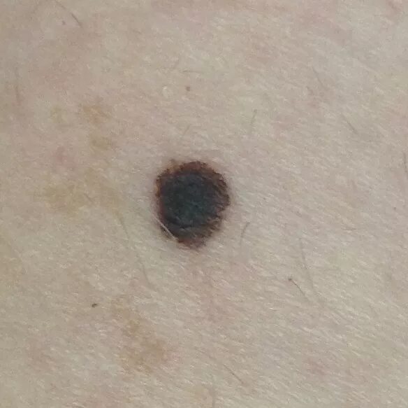 Плоскоклеточный рак кожи как выглядит фото Lada période longueur dark mole on leg Cuire Mathis Géométrie
