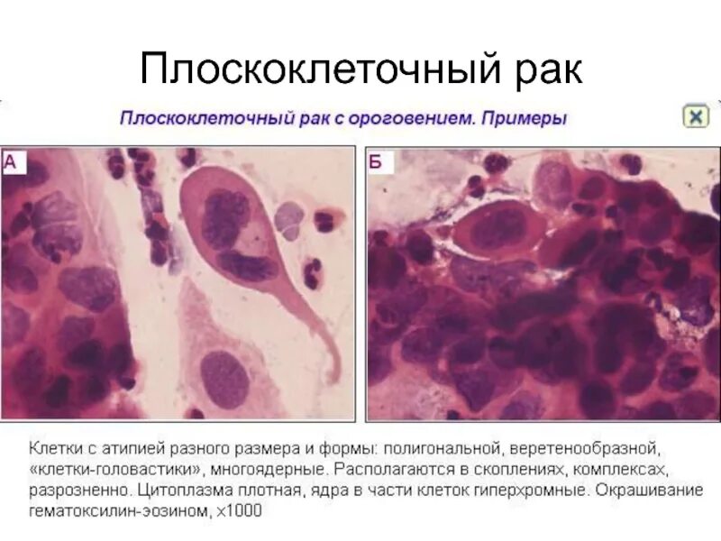 Плоскоклеточный рак кожи как выглядит фото Профилактика рака кожи
