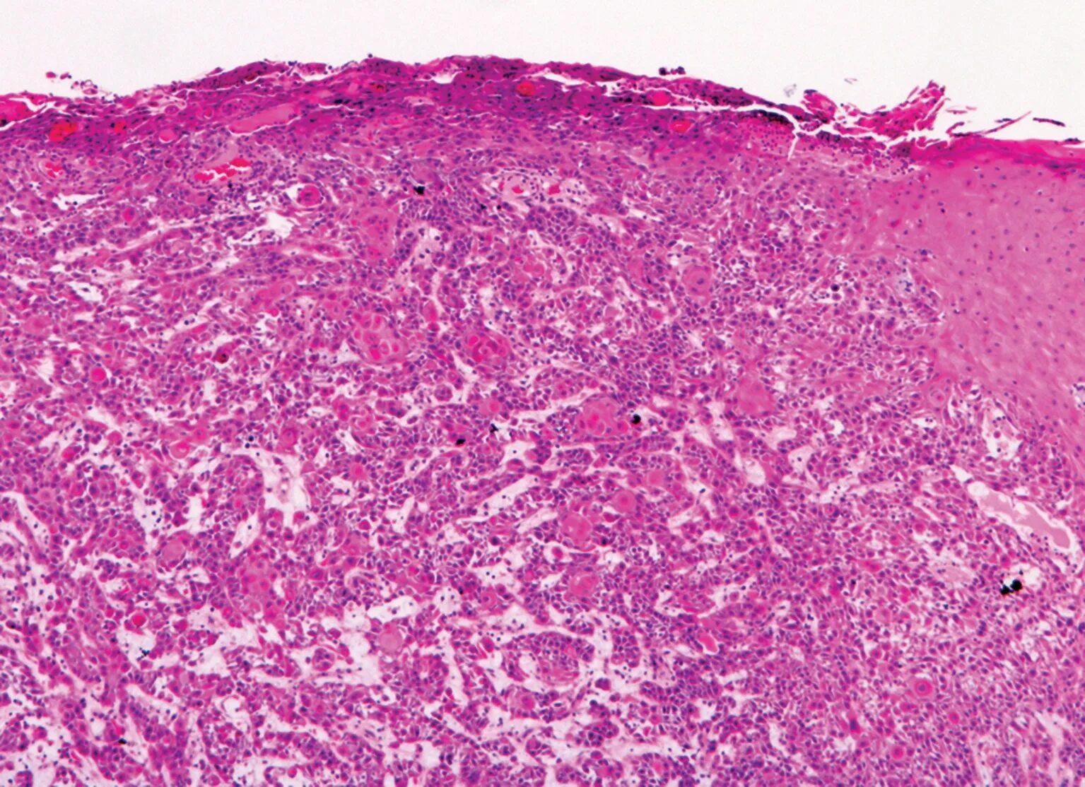 Плоскоклеточный рак кожи как выглядит фото File:Micrograph of moderately differentiated and invasive squamous-cell carcinom