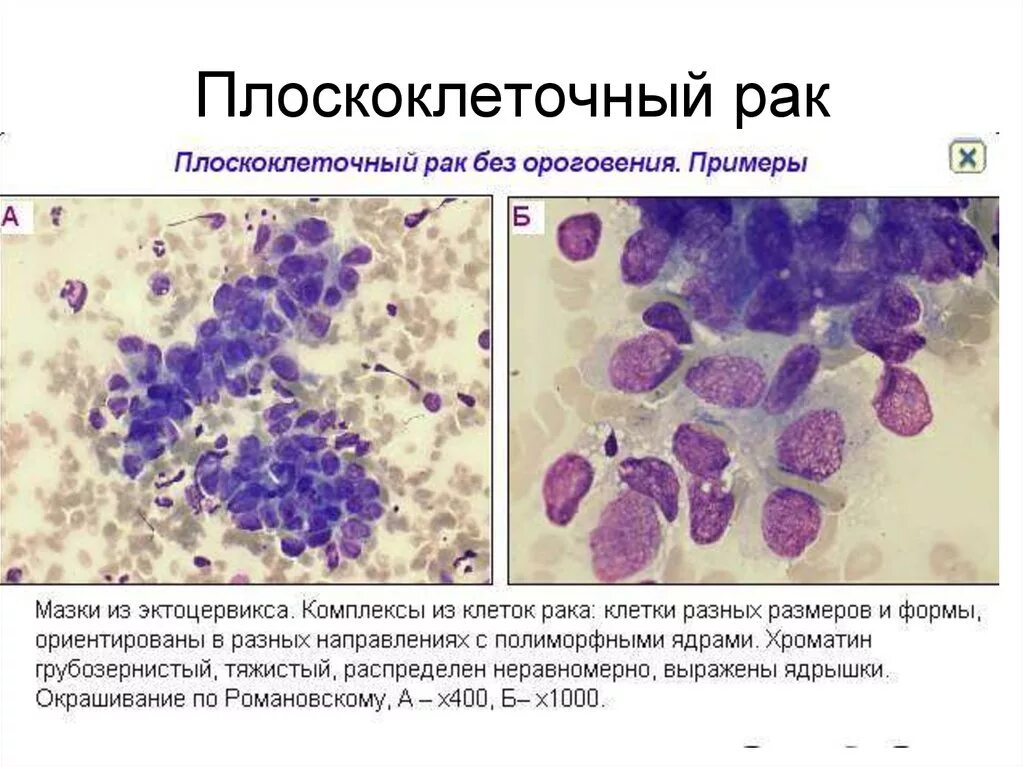 Плоскоклеточный рак кожи как выглядит фото Цитологическое исследование опухолей