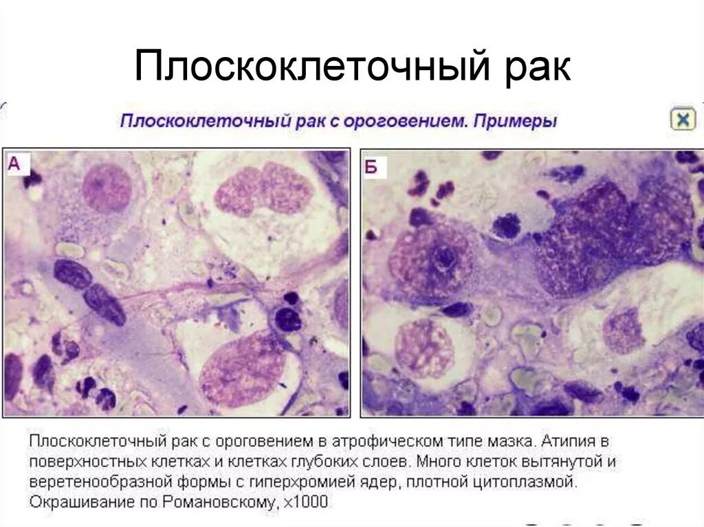 Плоскоклеточный рак кожи как выглядит фото Гистологическая картина плоскоклеточного рака