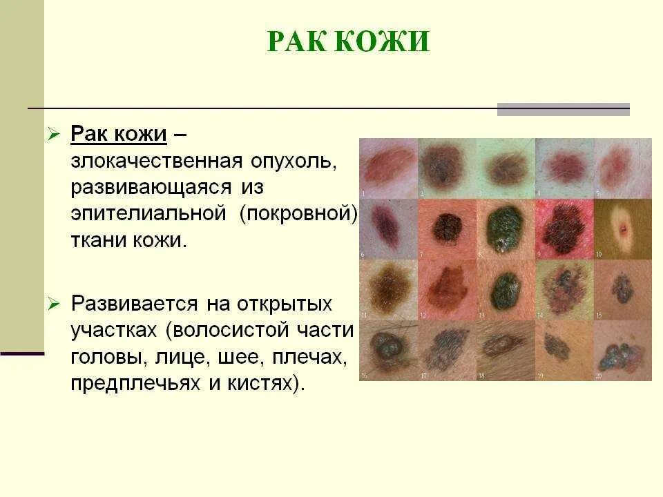 Плоскоклеточный рак кожи как выглядит фото Заболевания тканей