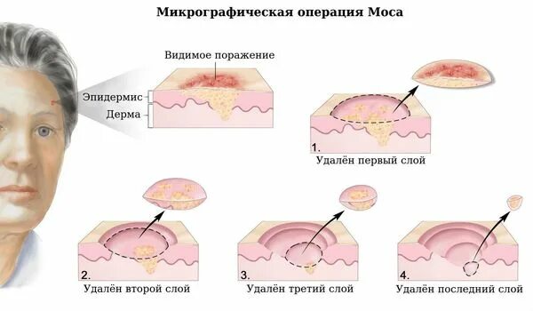 Плоскоклеточный рак кожи как выглядит фото Базалиома (базальноклеточный рак): причины, симптомы и лечение в статье онколога
