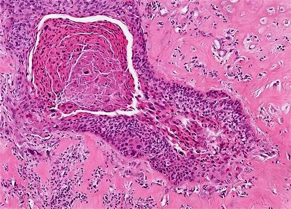 Плоскоклеточный рак неба фото solid tumors - head and neck Flashcards Quizlet