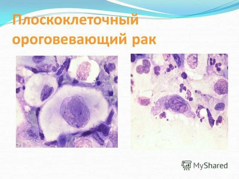 Плоскоклеточный рак неба фото Плоскоклеточный рак шейки матки - Olphoto.ru