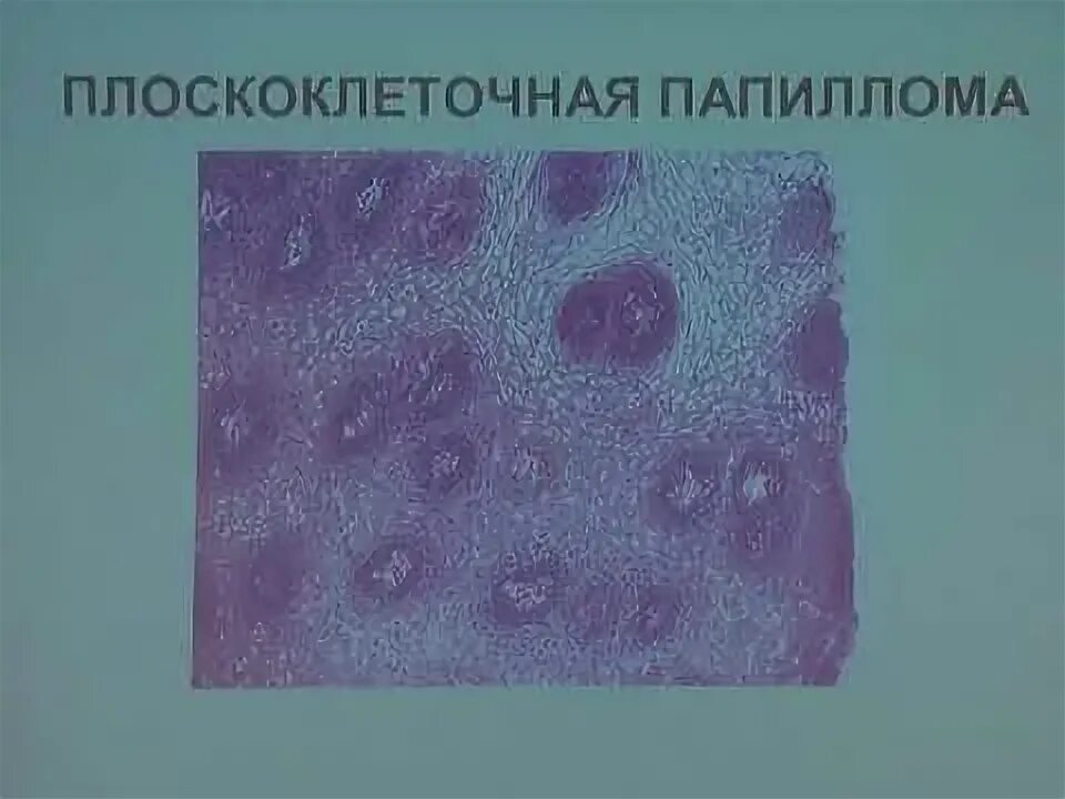 Плоскоклеточный рак неба фото Плоскоклеточная папиллома: чем опасна, ее симптомы и последствия, методы лечения