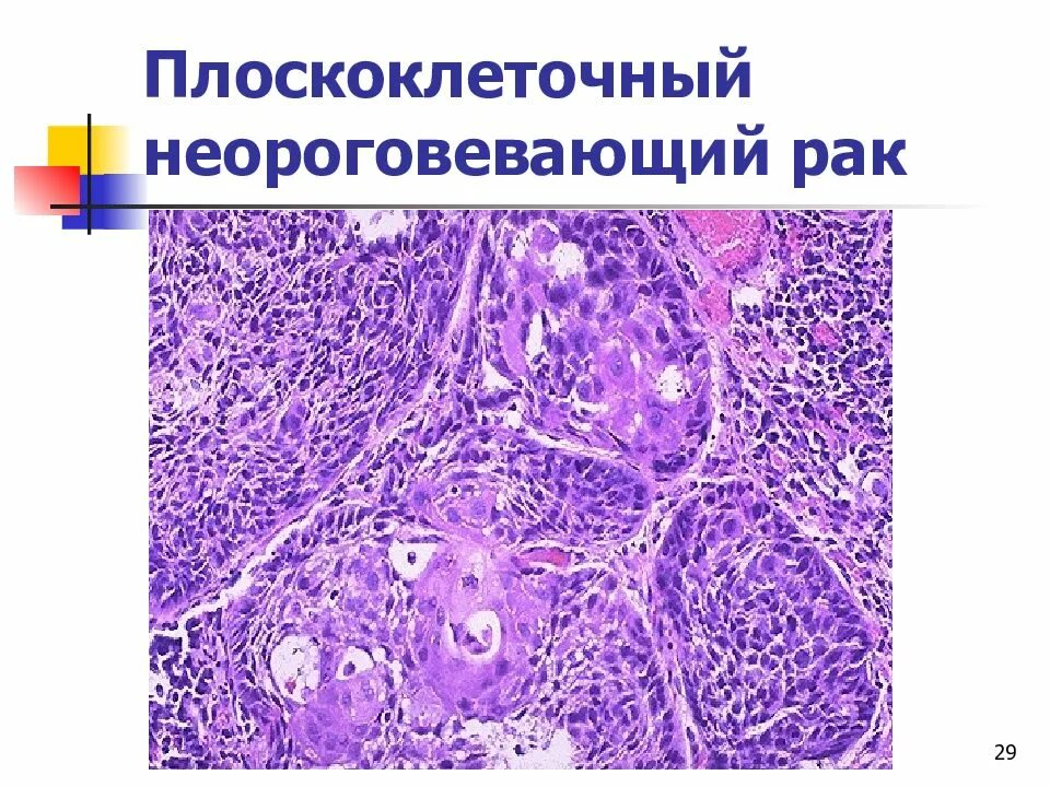 Плоскоклеточный рак неба фото Гистология рака