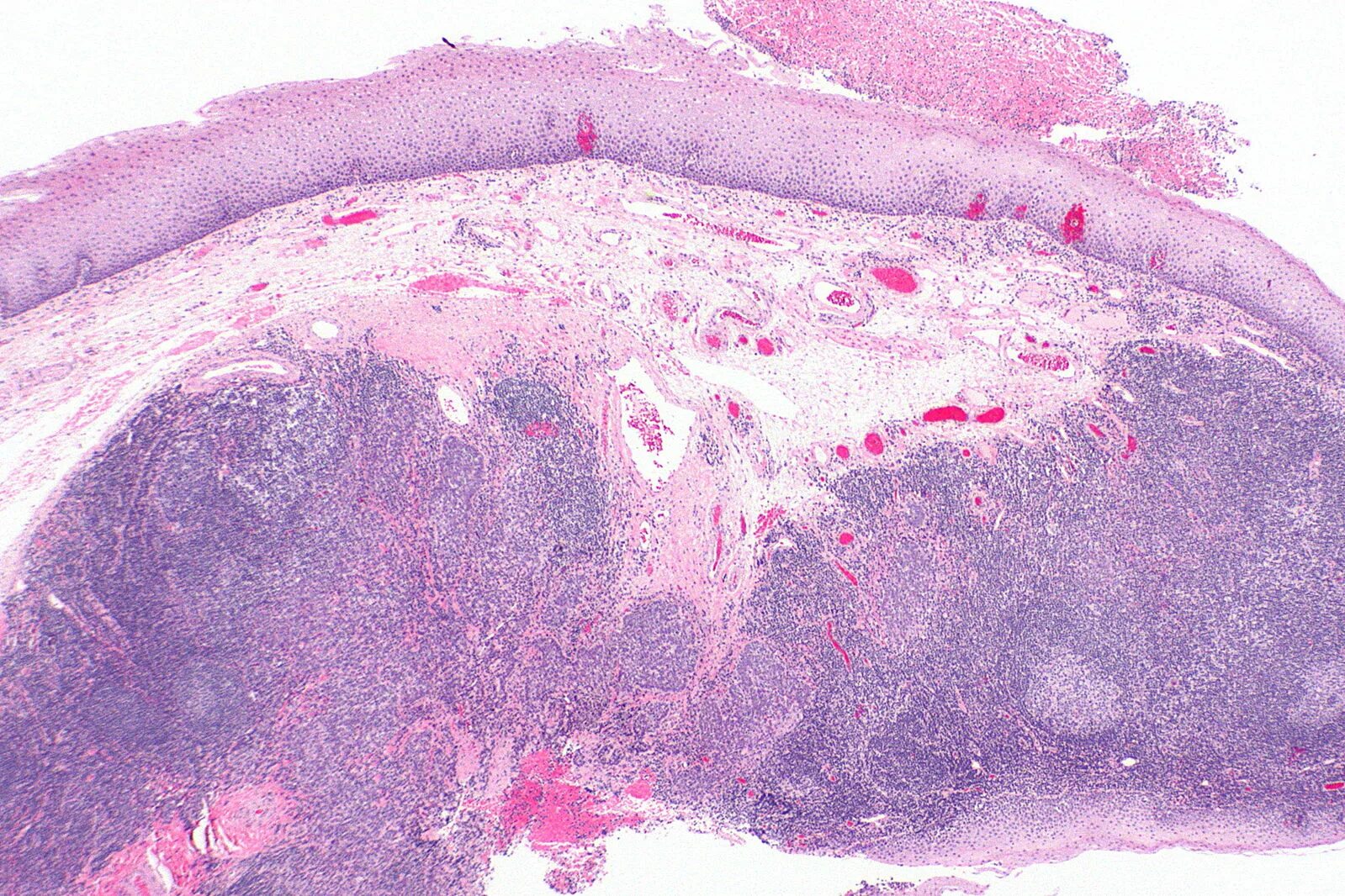 Плоскоклеточный рак неба фото File:Squamous cell carcinoma - p16 positive -- very low mag.jpg - Wikipedia