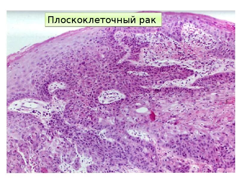 Плоскоклеточный рак неба фото Плоскоклеточный рак языка фото - ViktoriaFoto.ru