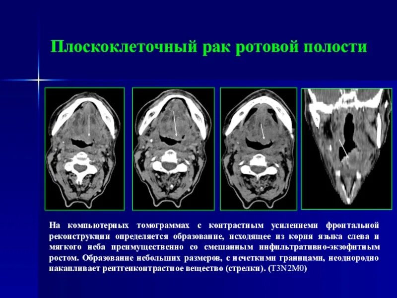 Плоскоклеточный рак неба фото Лучевая диагностика в онкологии презентация, доклад
