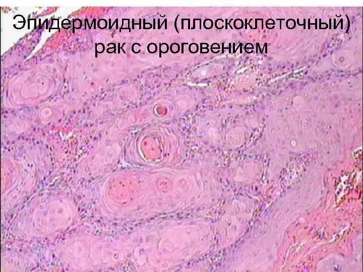 Плоскоклеточный рак неба фото Ороговевающий плоскоклеточный рак - Olphoto.ru