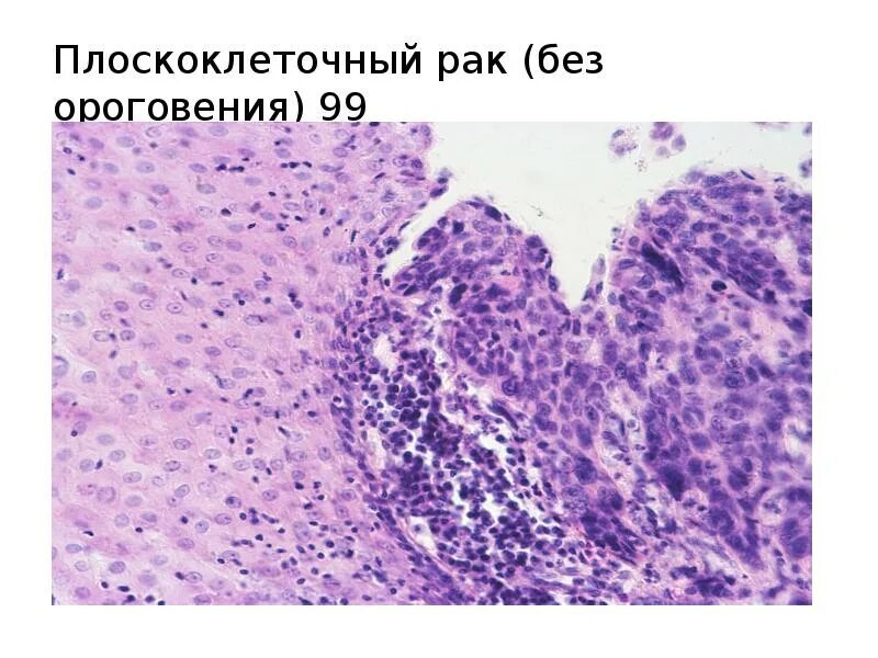Плоскоклеточный рак неба фото Плоскоклеточный рак языка фото - ViktoriaFoto.ru