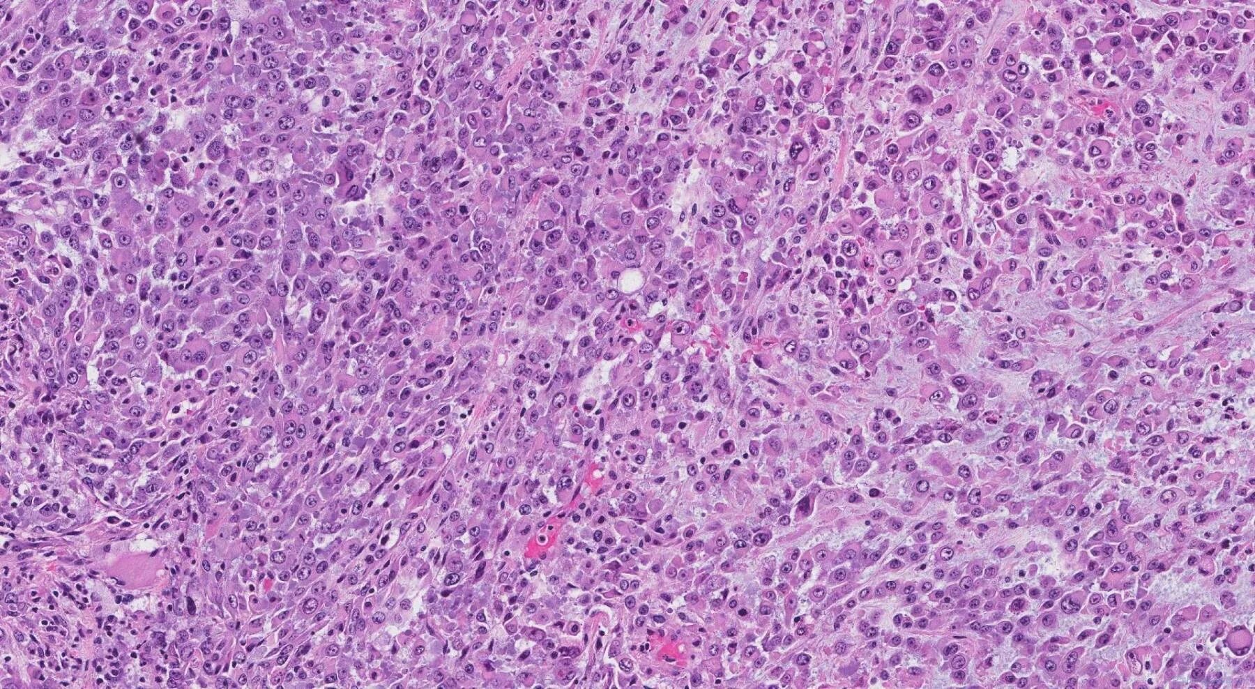 Плоскоклеточный рак симптомы фото epithelioid sarcoma Archives Atlas of Pathology