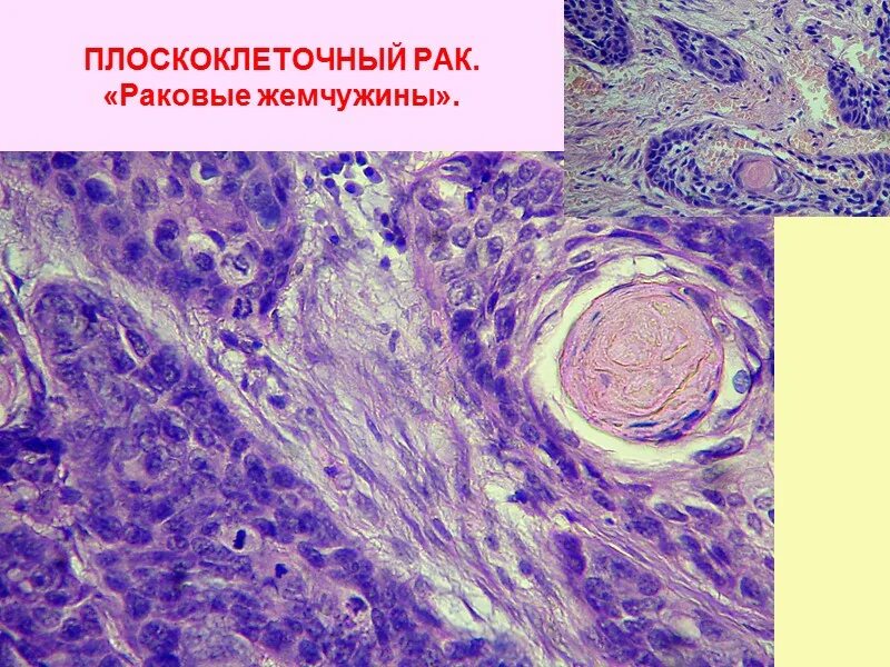 Плоскоклеточный рак симптомы фото Плоскоклеточный рак гистологически - найдено 89 картинок