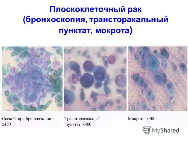 Плоскоклеточный рак симптомы фото Норма плоскоклеточной карциномы