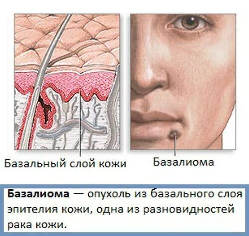 Плоскоклеточный рак симптомы фото лечение Базалиома носа: поражения слизистой кожи, операция по удалению на начальной стад