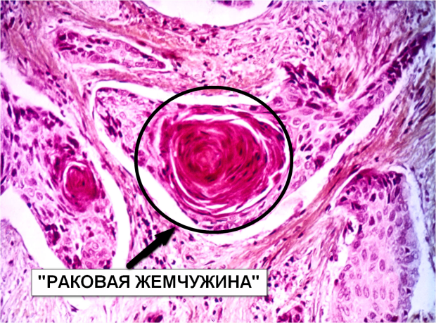 Плоскоклеточный рак симптомы фото лечение Плоскоклеточная неороговевающая карцинома: найдено 90 изображений