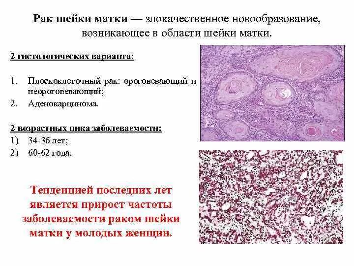 Плоскоклеточный рак симптомы фото лечение Типы рака шейки матки Плоскоклеточная карцинома и Аденокарцинома