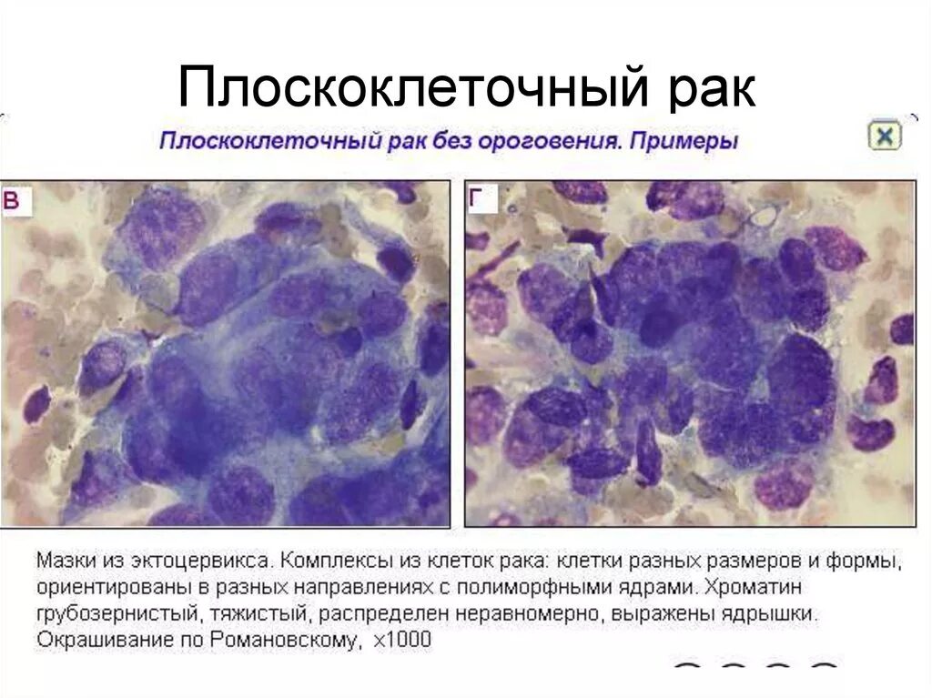 Плоскоклеточный рак симптомы фото лечение Злокачественная лимфоидная ткань