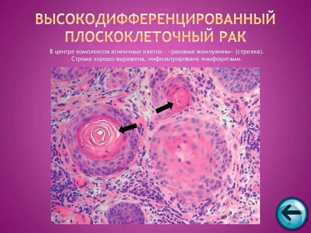 Плоскоклеточный рак симптомы фото лечение Гистологическая картина плоскоклеточного рака