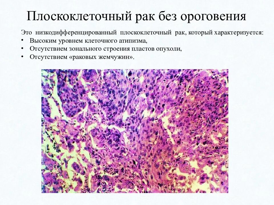 Плоскоклеточный рак симптомы фото лечение Плоскоклеточная низкодифференцированная карцинома: найдено 89 изображений