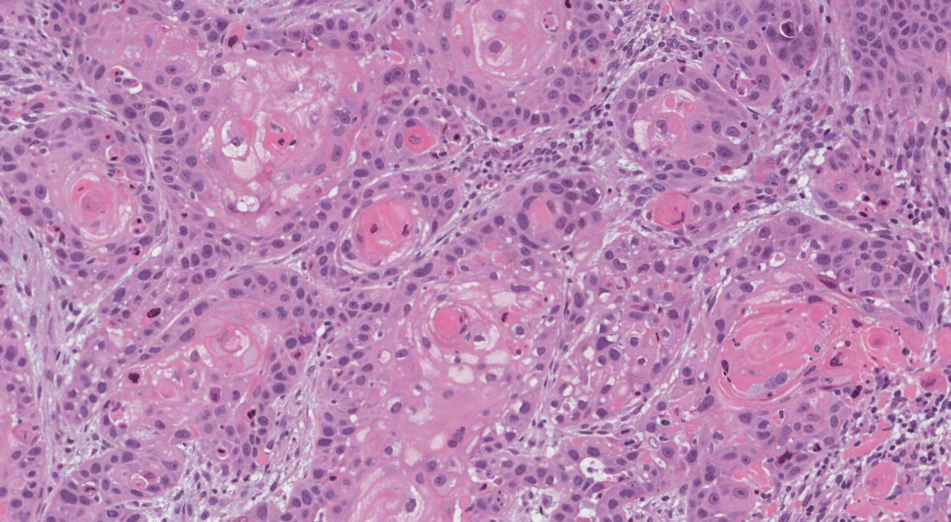 Плоскоклеточный рак симптомы фото лечение Keratinizing squamous cell carcinoma of the nasal cavity and sinuses MyPathology