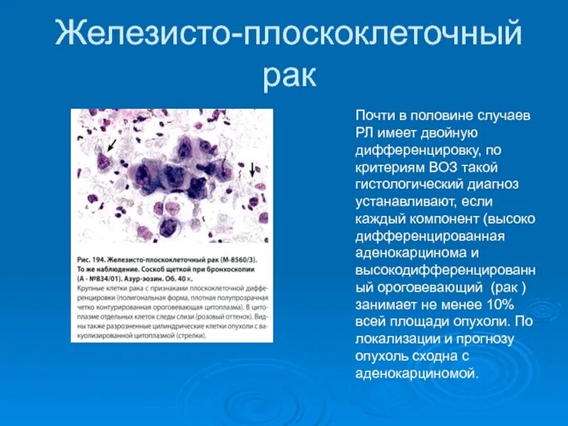Плоскоклеточный рак симптомы фото лечение Гистологическая картина плоскоклеточного рака