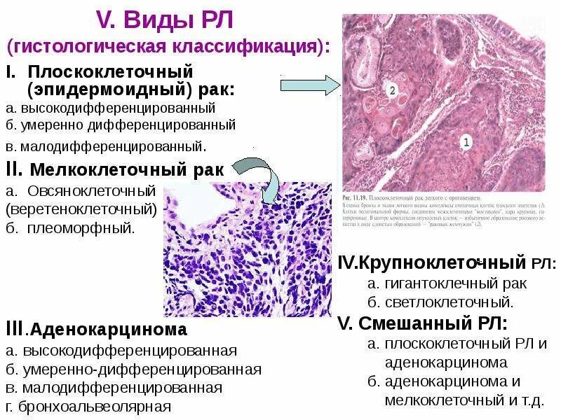 Плоскоклеточный рак симптомы фото лечение я рак легкого (10) - презентация, доклад, проект скачать