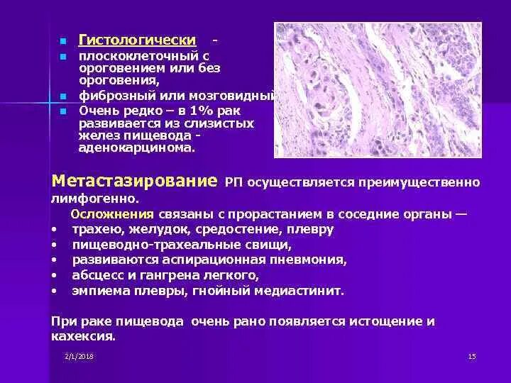 Плоскоклеточный рак симптомы фото лечение Плоскоклеточный Рак Пищевода