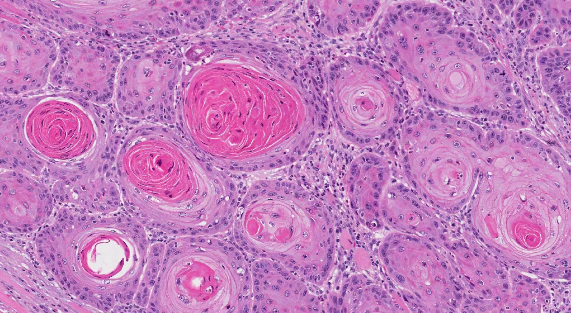 Плоскоклеточный рак симптомы фото лечение Squamous cell carcinoma of the oral cavity MyPathologyReport.ca
