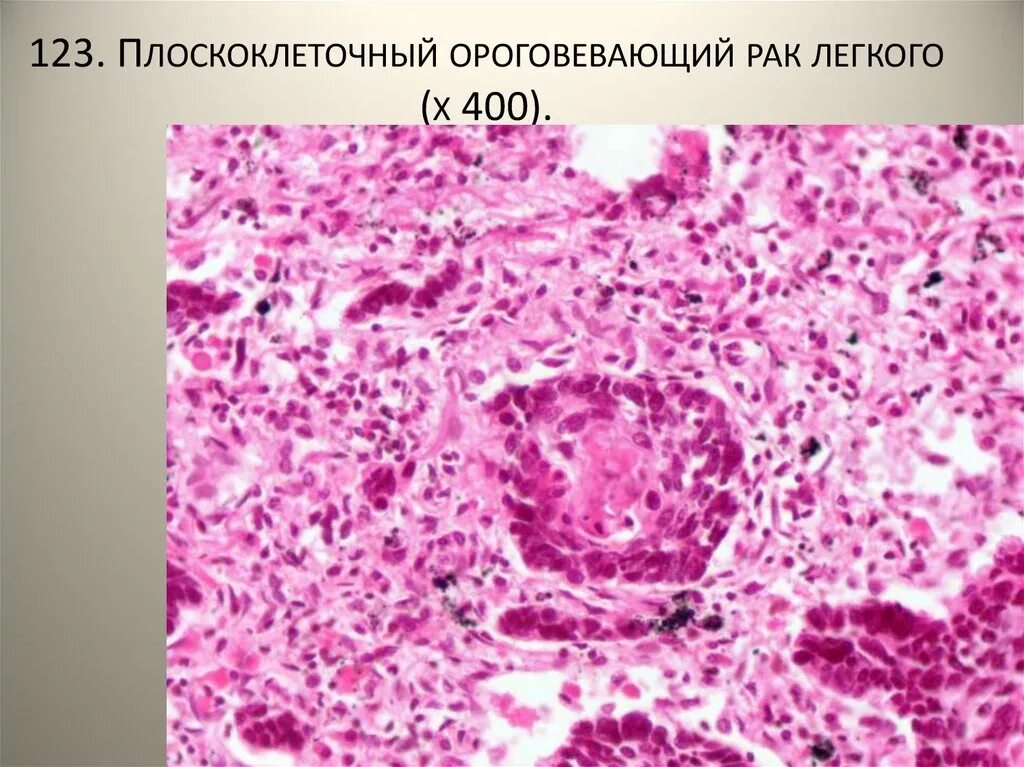 Плоскоклеточный рак симптомы фото лечение Плоскоклеточный рак легкого: диагностика и лечение