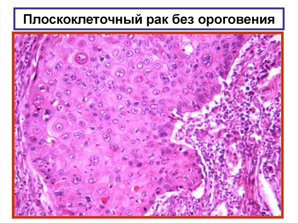 Плоскоклеточный рак уха фото Плоскоклеточный высокодифференцированный рак: Плоскоклеточный рак: высокодиффере