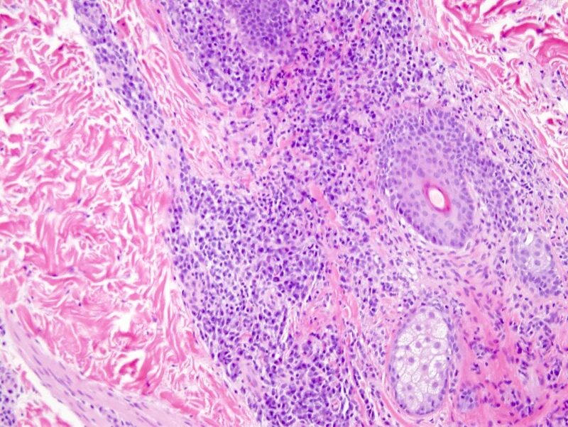 Плоскоклеточный рак уха фото Secondary Syphilis Dermatopathology