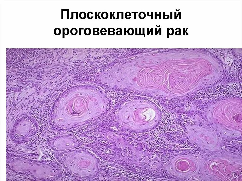 Плоскоклеточный рак уха фото Инвазивный плоскоклеточный