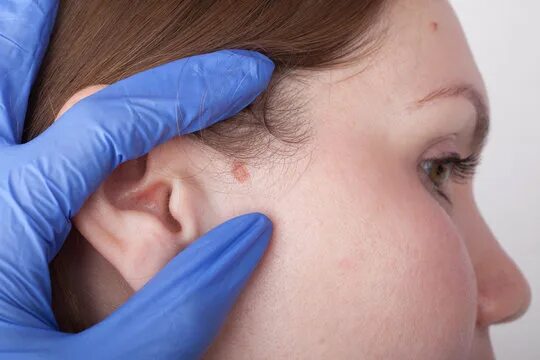Плоскоклеточный рак уха фото Wart Removal Зображення - огляд 42,027 Стокові фото, векторні зображення й відео
