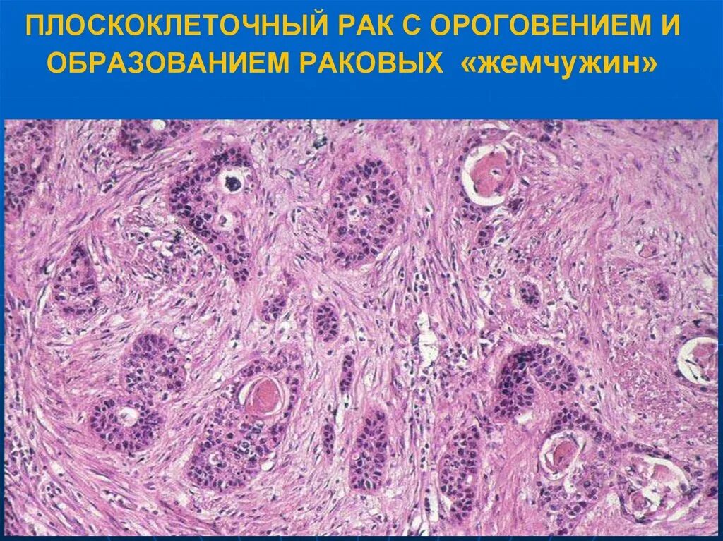 Плоскоклеточный рак уха фото Дифференцировки плоскоклеточного рака - найдено 87 картинок