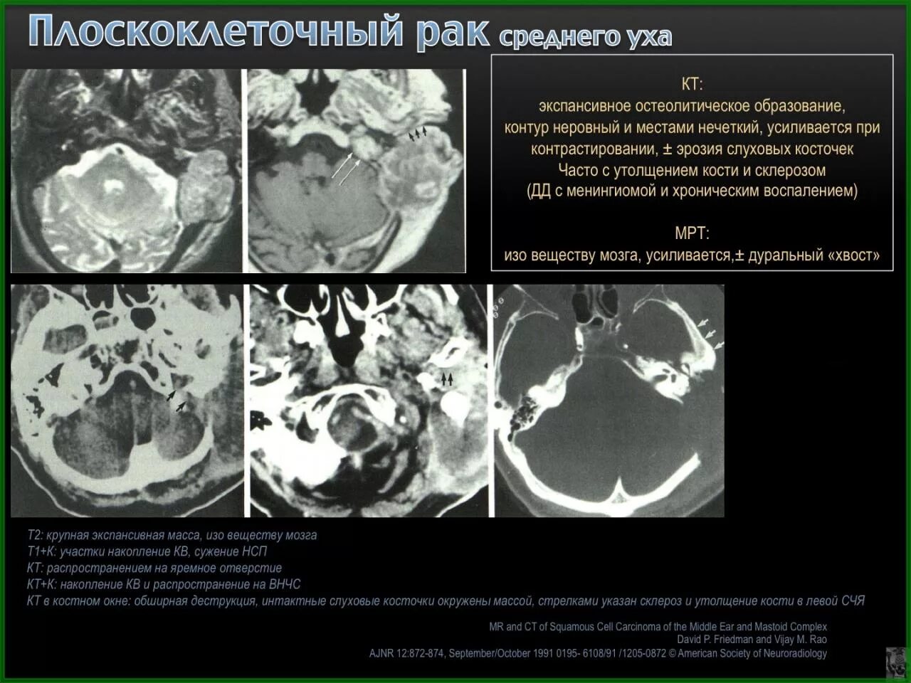 Плоскоклеточный рак уха фото КТ-диагностика опухолей среднего и внутреннего уха