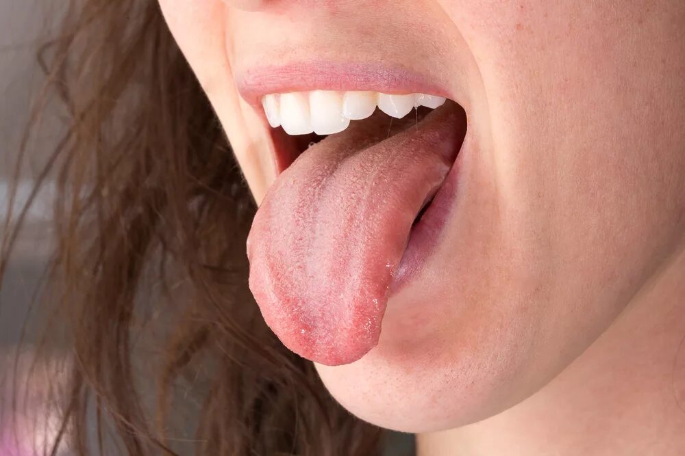 Плоскоклеточный рак языка фото симптомы и лечение PICOR DE LENGUA - Estudi Dental Barcelona